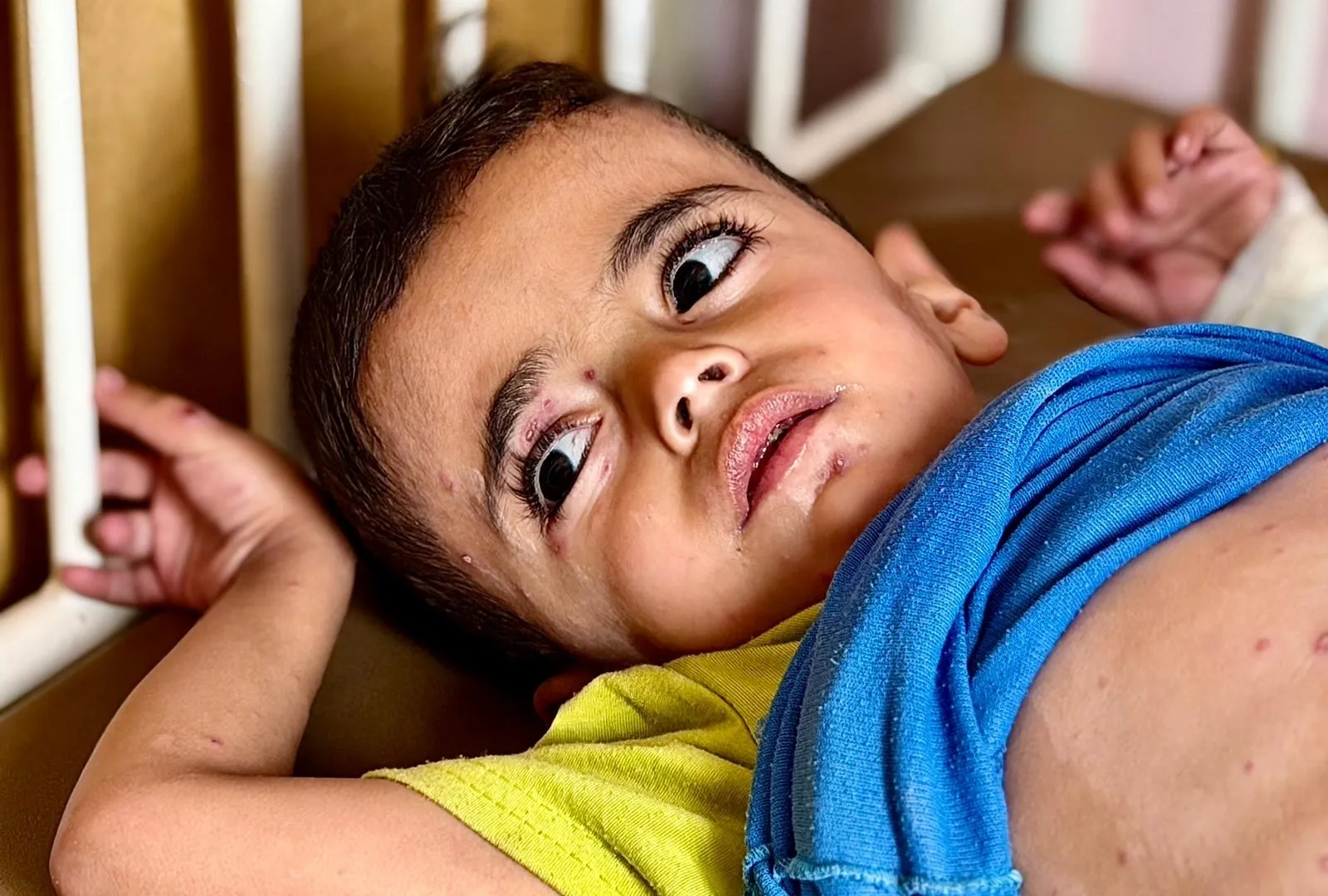 Burn-like rashes and hunger: Gaza’s children face skin disease crisis